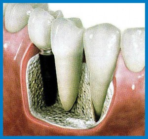 implantologia dental